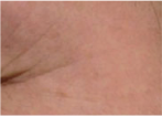 Skin image before treatment taken using digital
